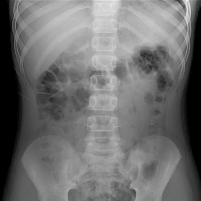 Radiografía de abdomen adquirida con Rover Plus
