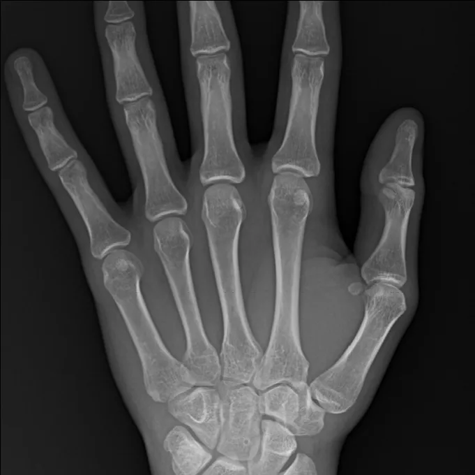 Radiografía de mano adquirida con Rover Plus